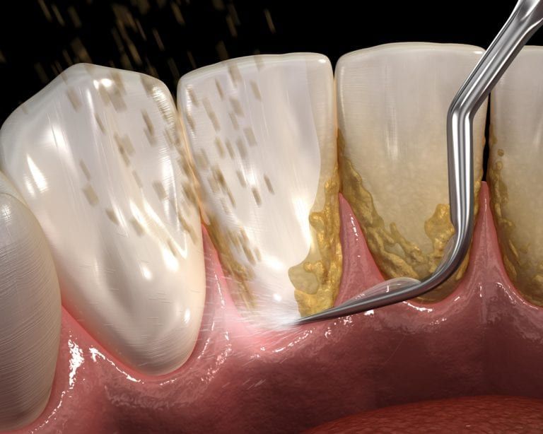 An example of Scaling and Root Planing also known as Periodontal Scaling