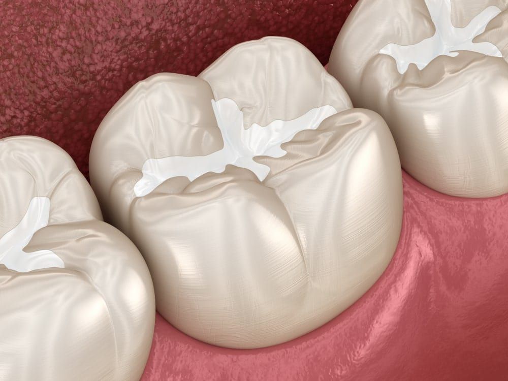 Example of Dental Sealants on a molar