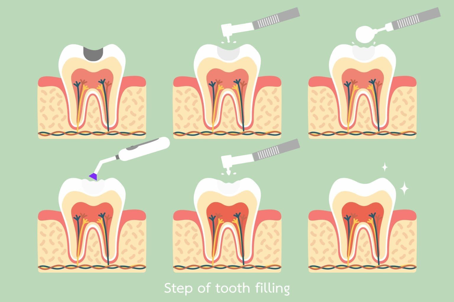 Diagram of the process of getting Composite Tooth Colored fillings