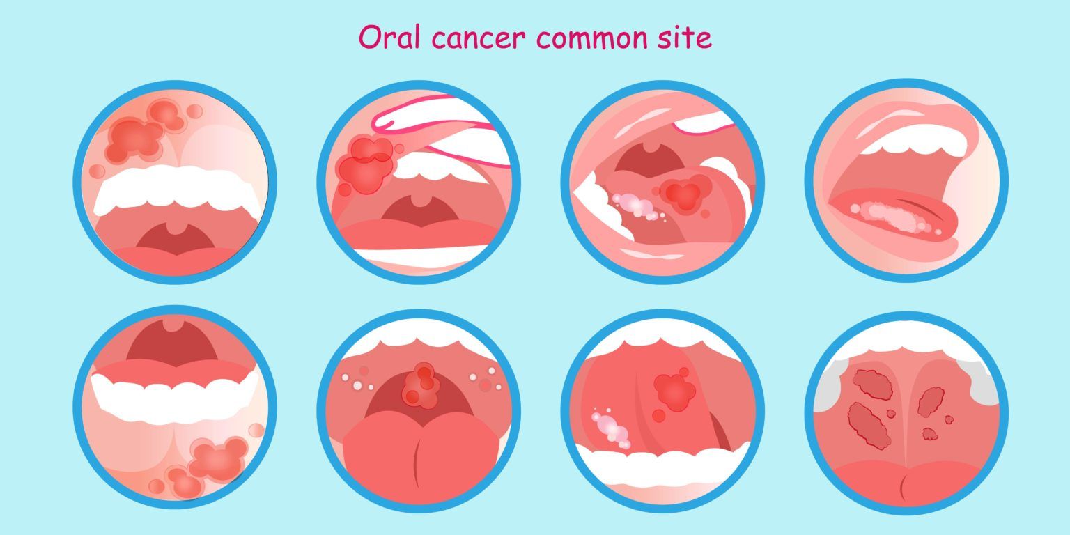 Diagram of different parts of the mouth that dentist check for an oral cancer screening.