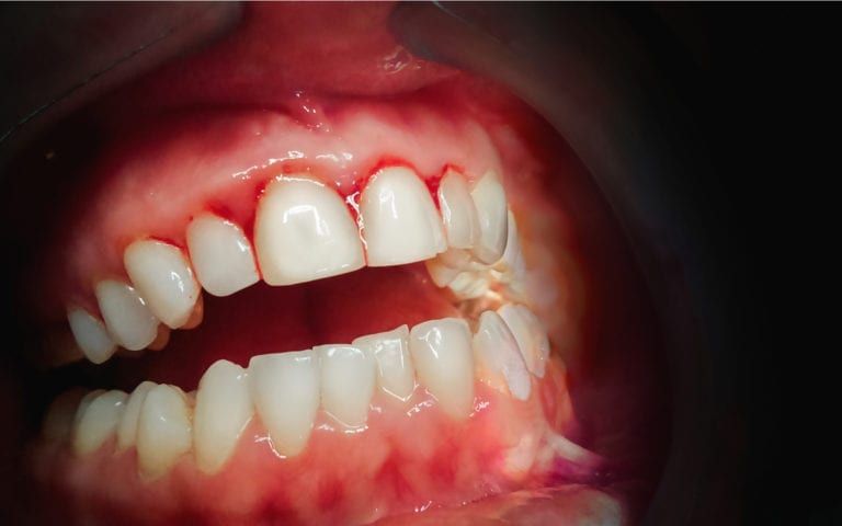Gums with periodontal disease