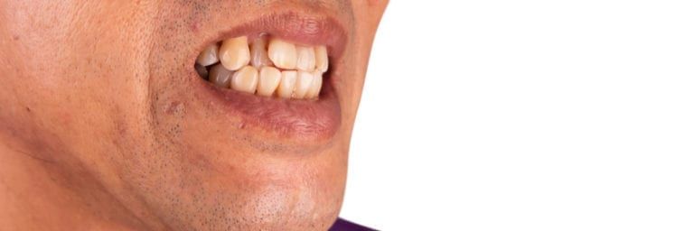 Man with protruding teeth