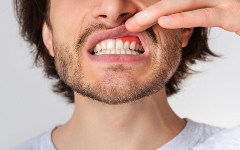 Man baring gums with gum disease