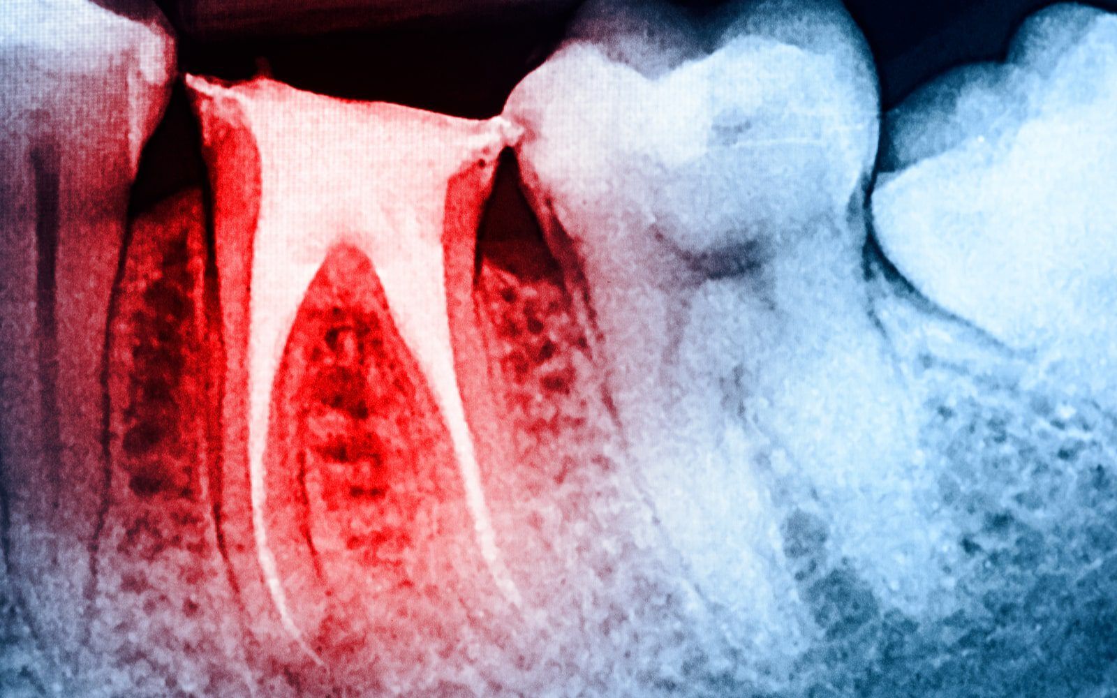 Root Canal Imaging