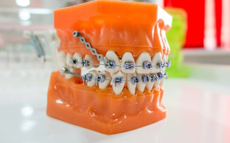 Dental Anchorage Model