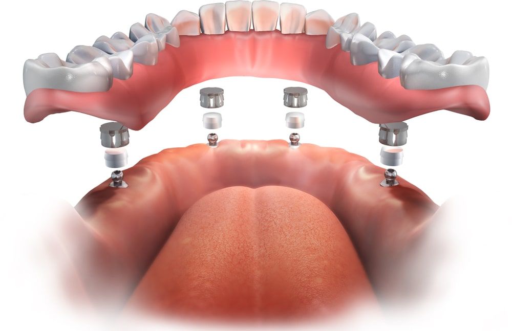 An example of All-On-4 Dentures