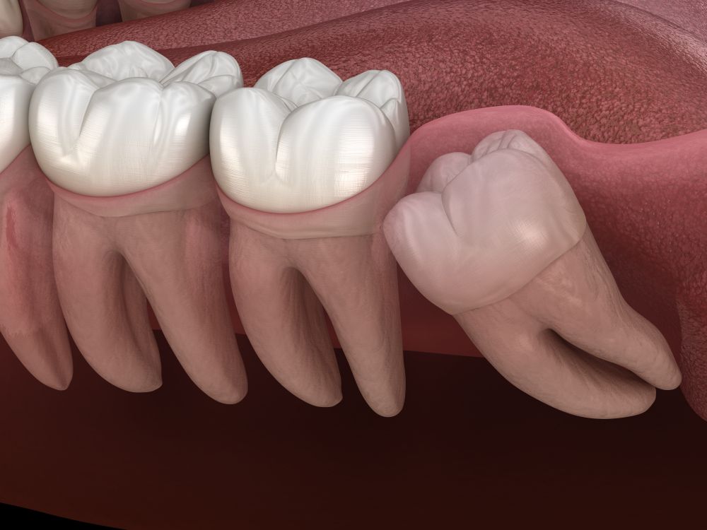 An example of a Bony Impacted ready for Wisdom Teeth Removal