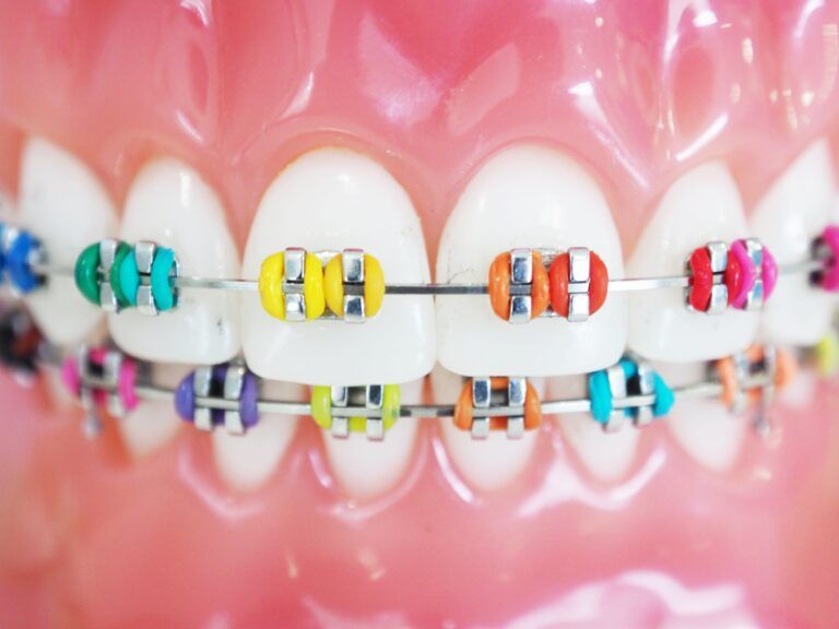 closeup of braces on a dental mouth model