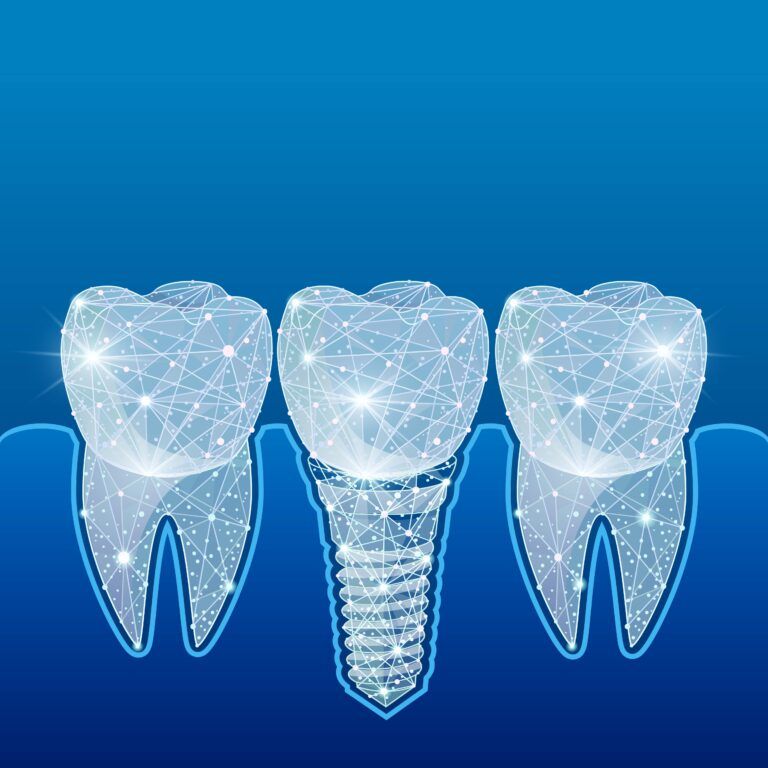 dental implant technology concept