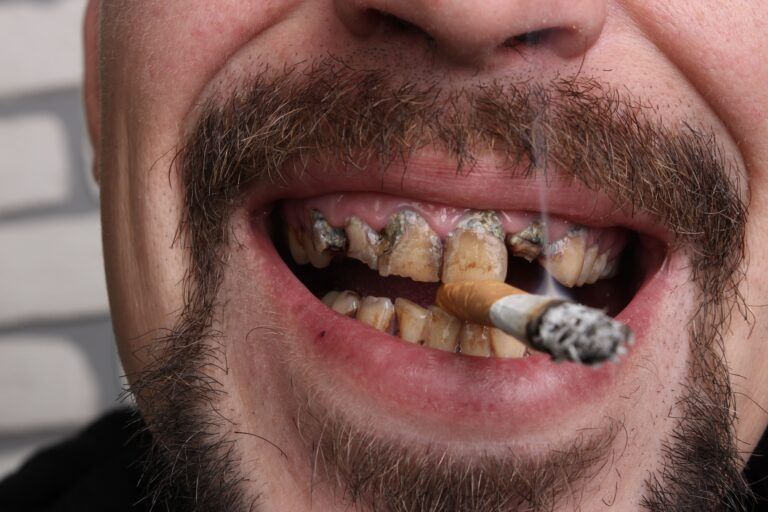 man with gross teeth smoking a cigarette