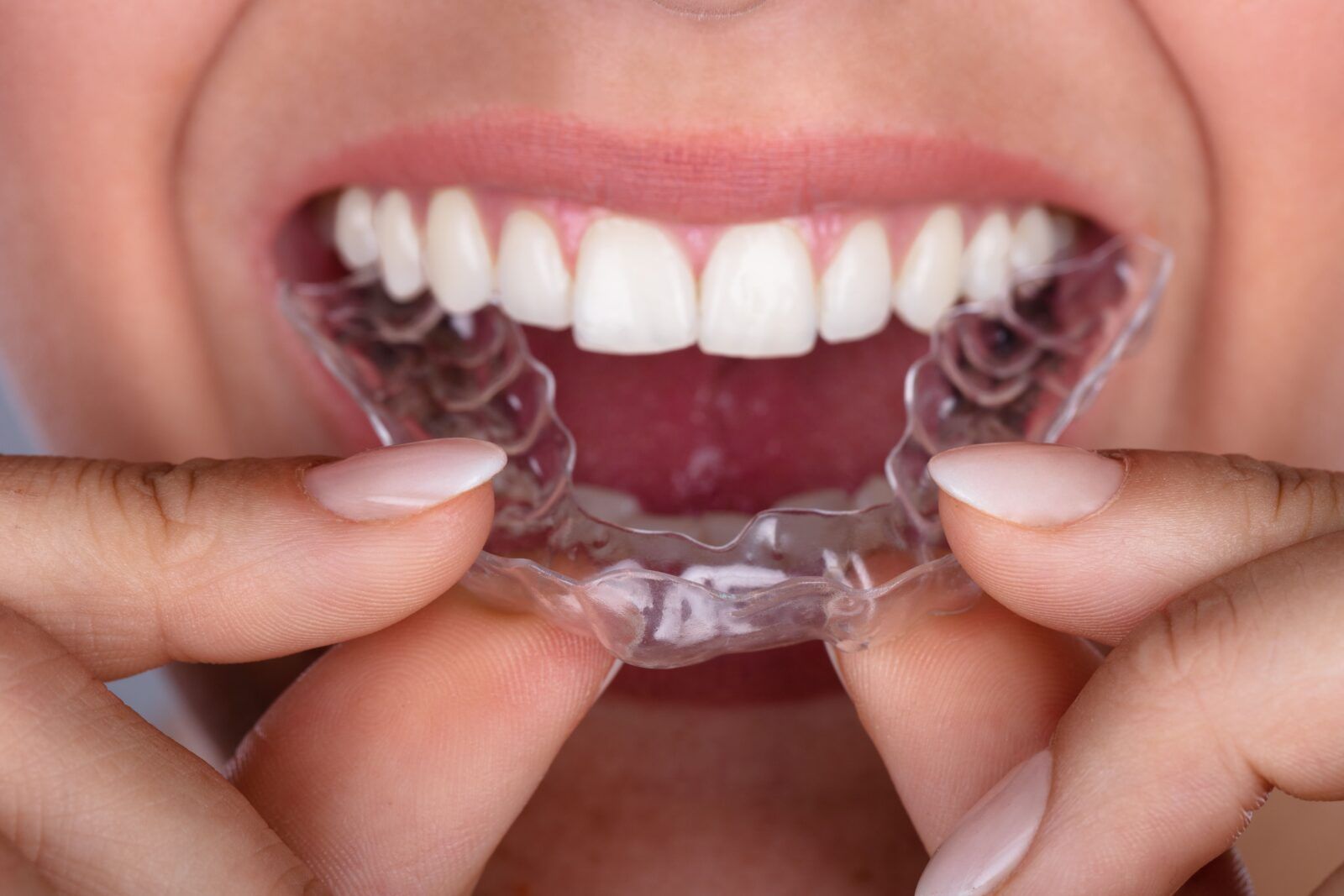 clear aligner being put in the mouth