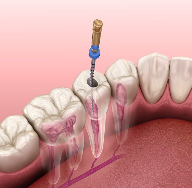 root canal being performed on premolar