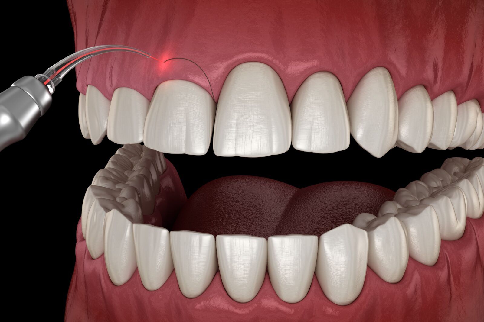 The Benefits of Gum Contouring for Smile Enhancement | 3D Dentistry ...