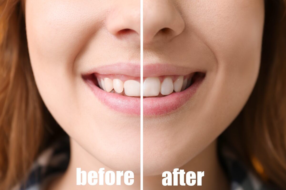 before and after gum contouring treatment