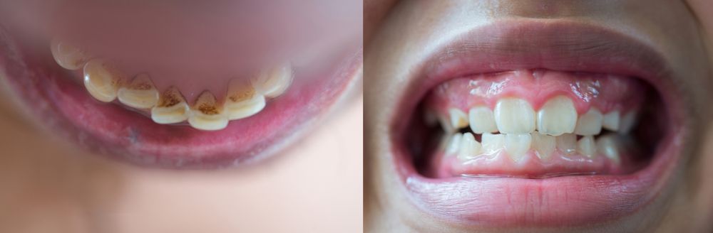 Understanding the Process of Tooth Erosion