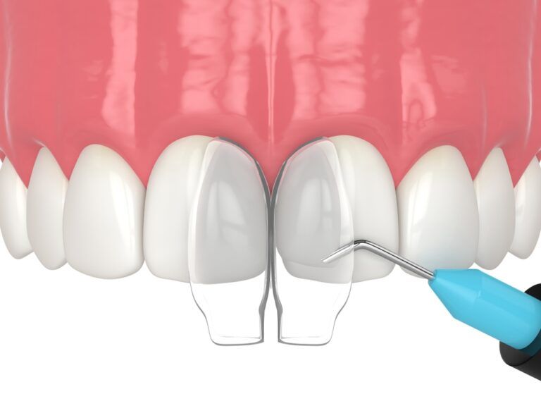 What You Need to Know About Dental Bonding