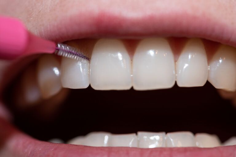 The Importance of Interdental Cleaning